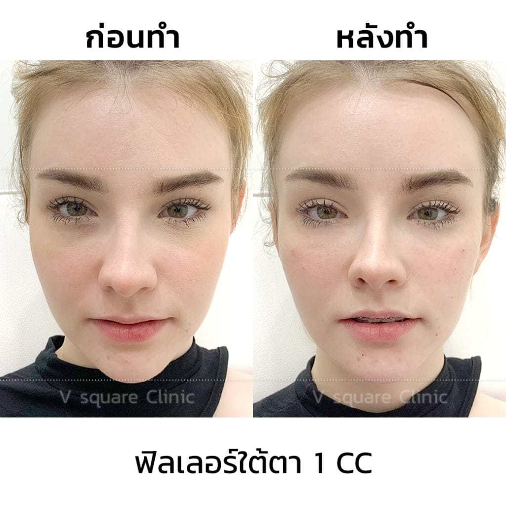 รีวิว-ฟิลเลอร์ใต้ตา1cc-เจสซี่