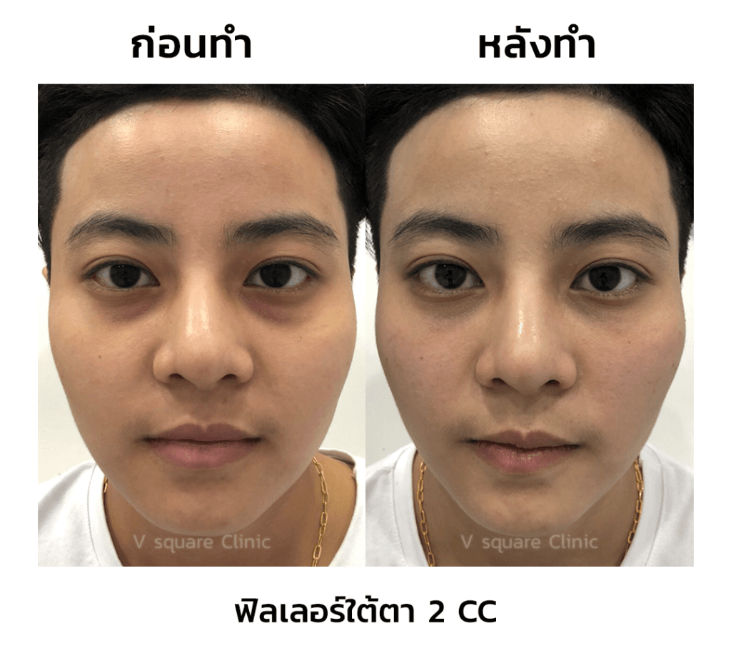รีวิวฉีดฟิลเลอร์ใต้ตา-2-CC