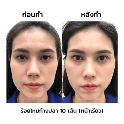 รีวิวร้อยไหมหน้าเรียว