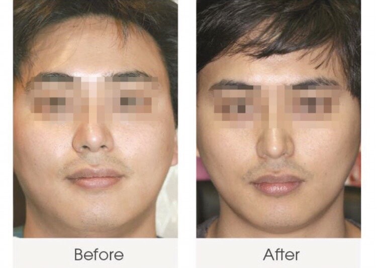 รีวิว-เมโสแฟต-ฉีดหน้าเรียว