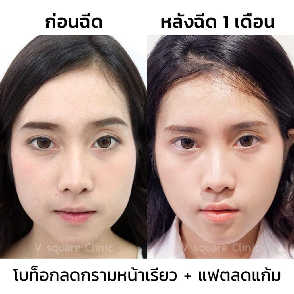 รีวิวโบท็อกลดกราม-ทำหน้าเรียว