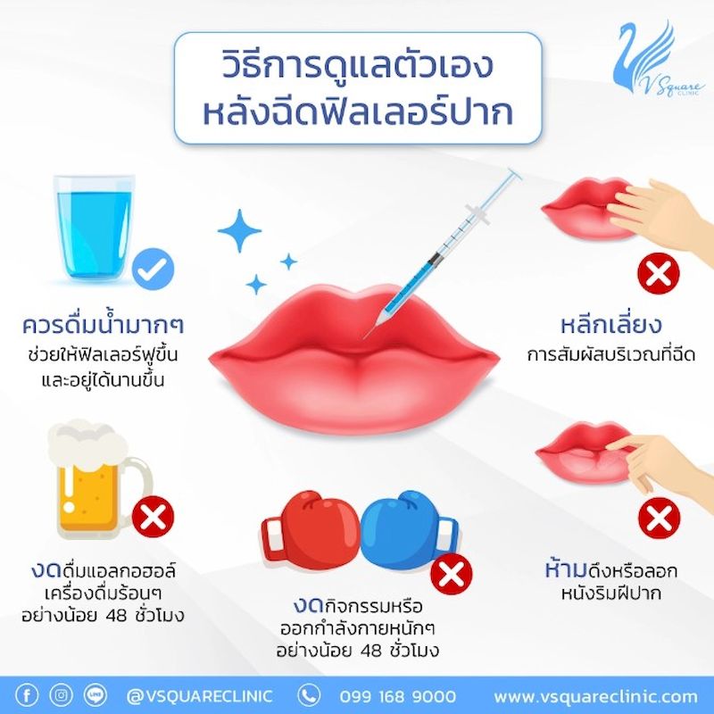 วิธีดูแลตัวเอง หลังจากฉีดฟิลเลอร์ปาก