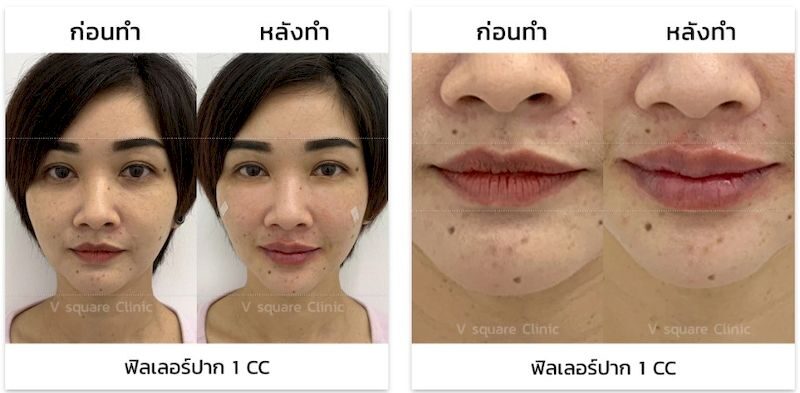 รีวิว ฉีดฟิลเลอร์ปาก 1 cc