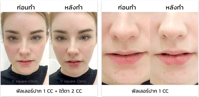 รีวิว ฉีดฟิลเลอร์ปาก 1 cc และฉีดฟิลเลอร์ใต้ตา 2 cc